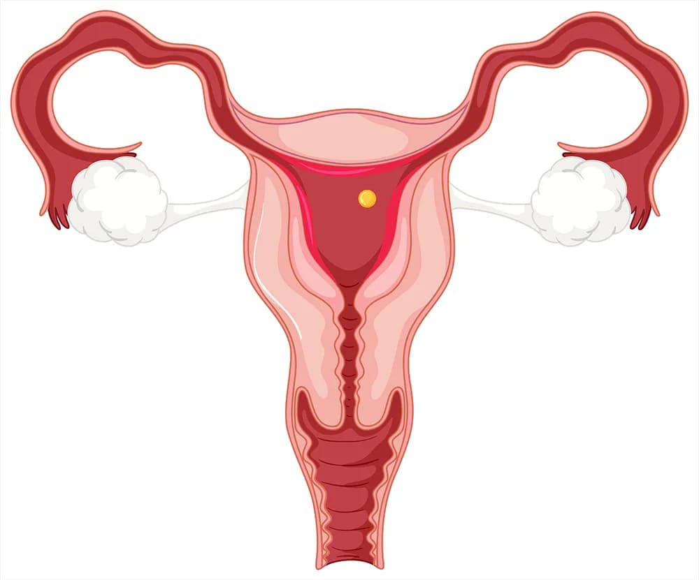 Medical illustration of a uterus cut open to show the cavity, with the fallopian tubes and ovaries either side and a small yellow polyp on the lining