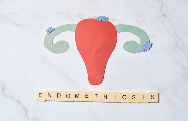 Endometriosis (Causes, Symptoms, Diagnosis & Treatment)